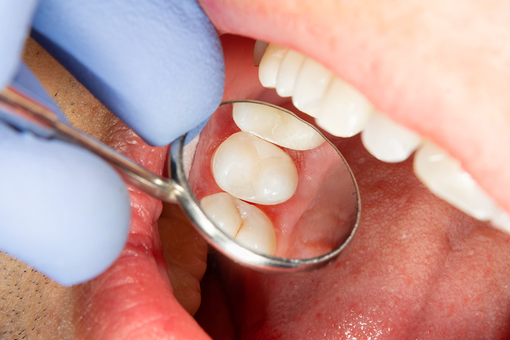 What are the benefits of dental sealants