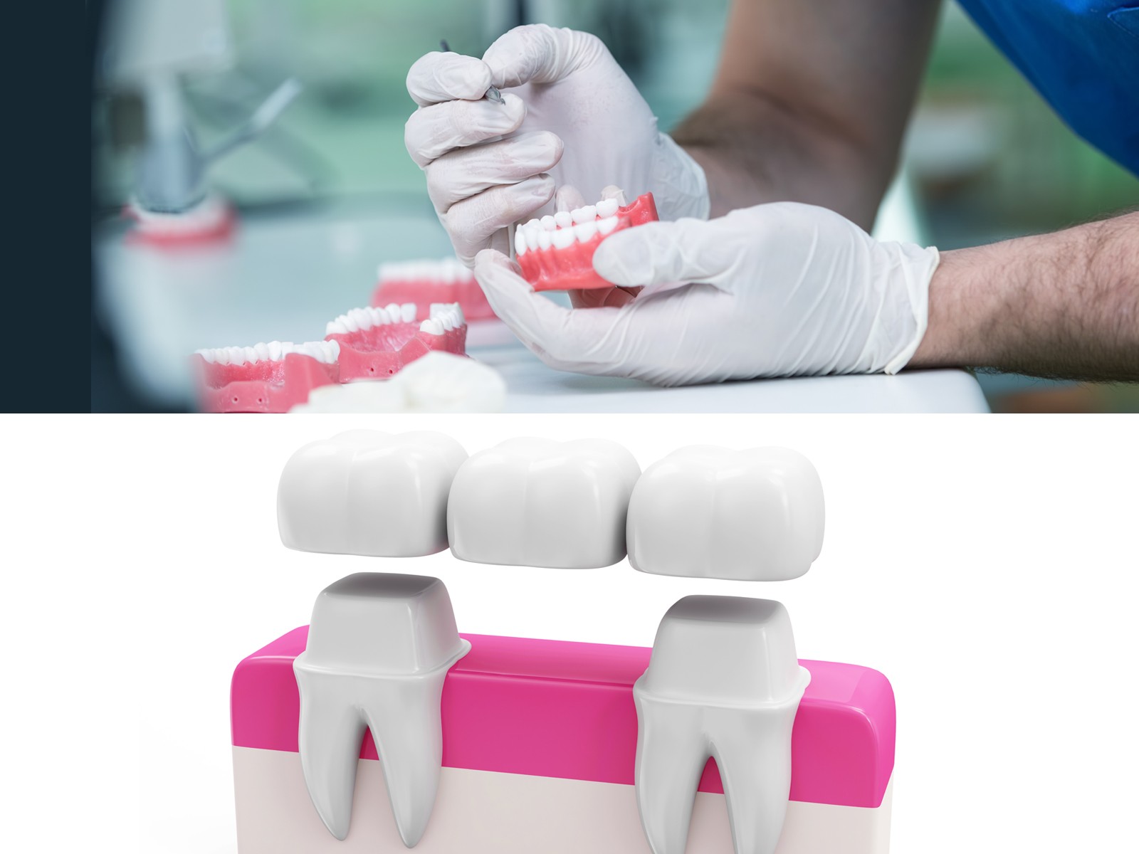 What is the difference between dentures and bridges?