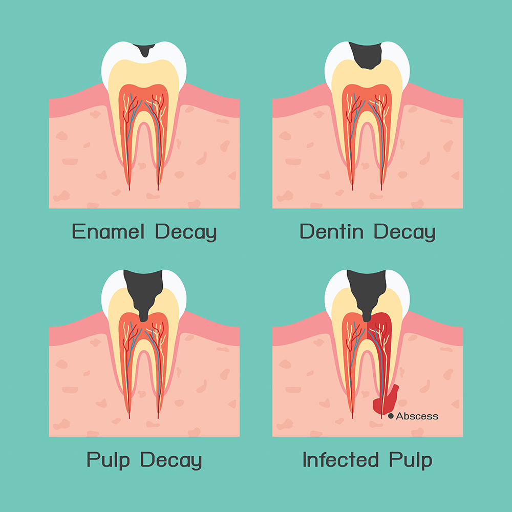 Does Oatmeal Cause Tooth Decay?