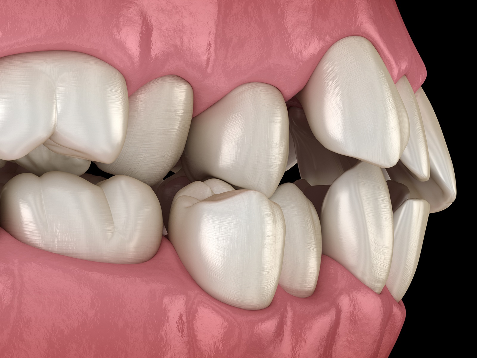 What Causes Protruding Teeth in Adults?