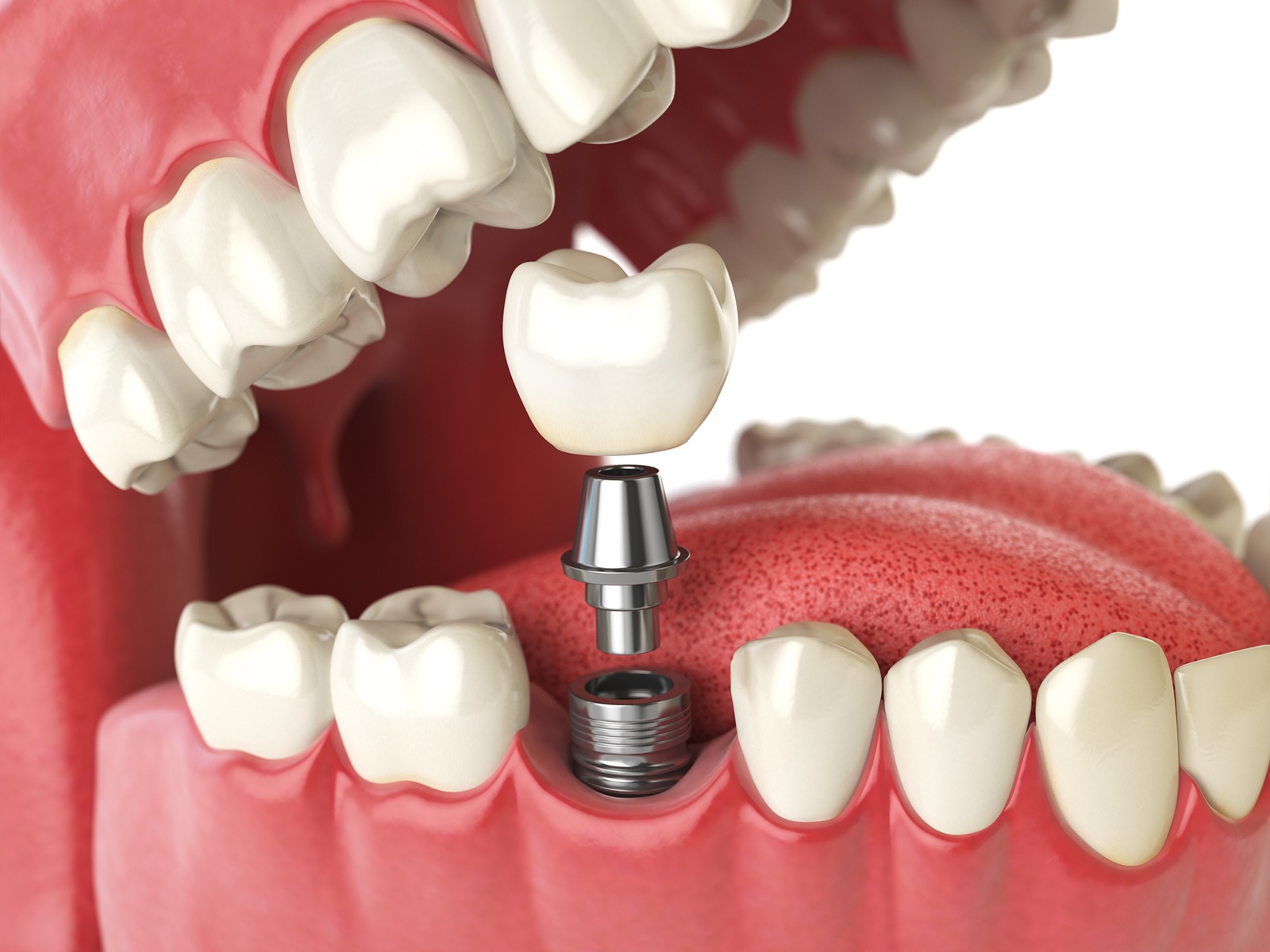 Can 1 implant replace 2 teeth?