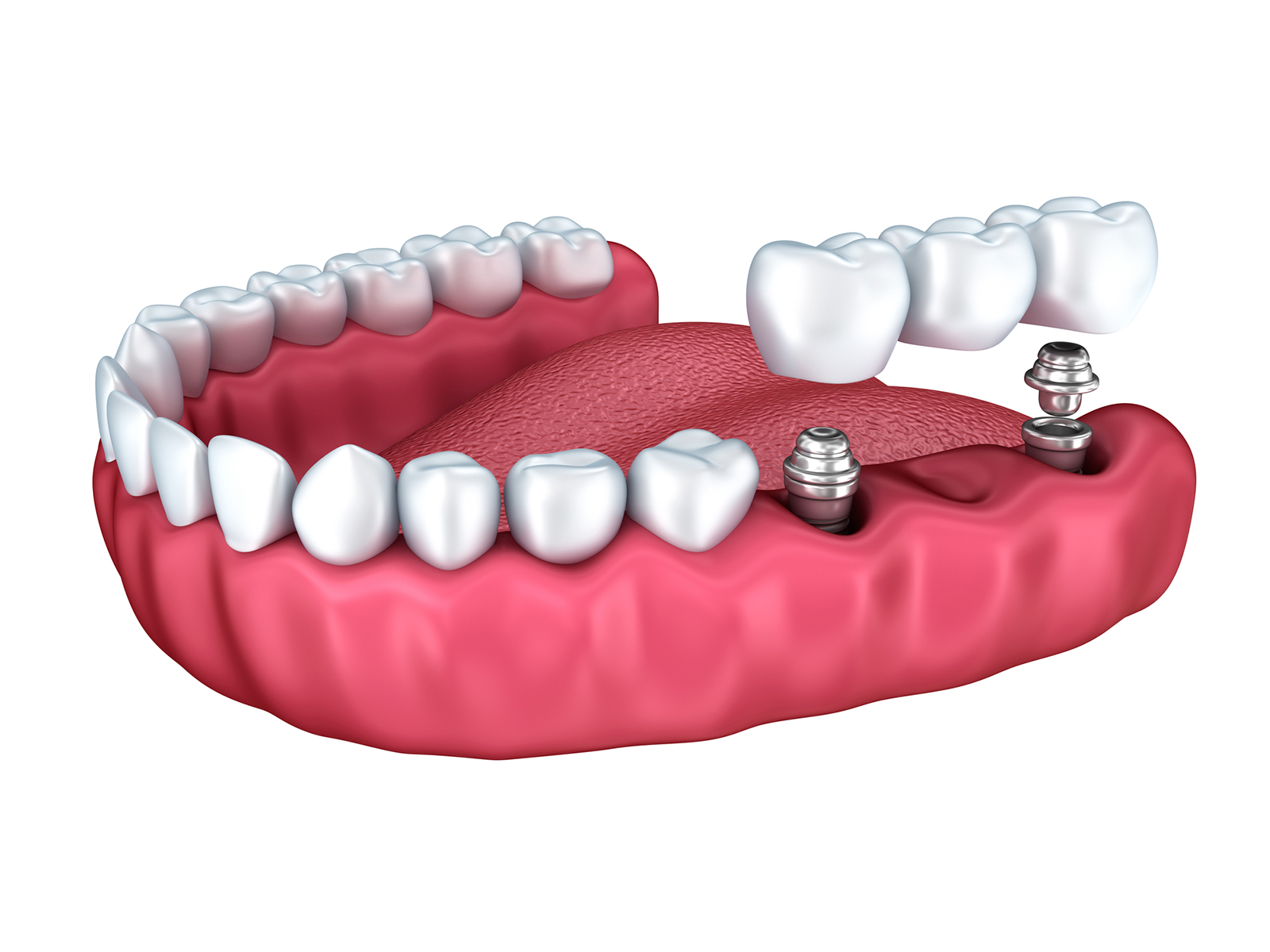 Do dental implants shorten your life?