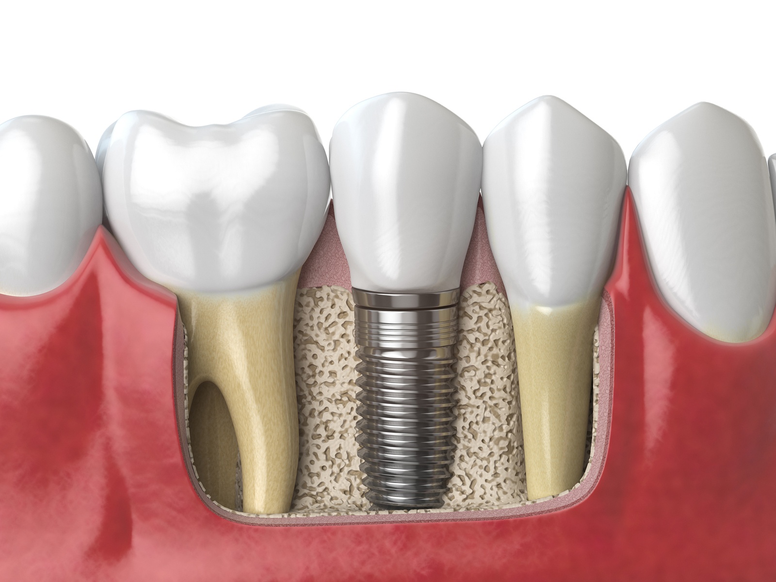 What is the downside of dental implants?