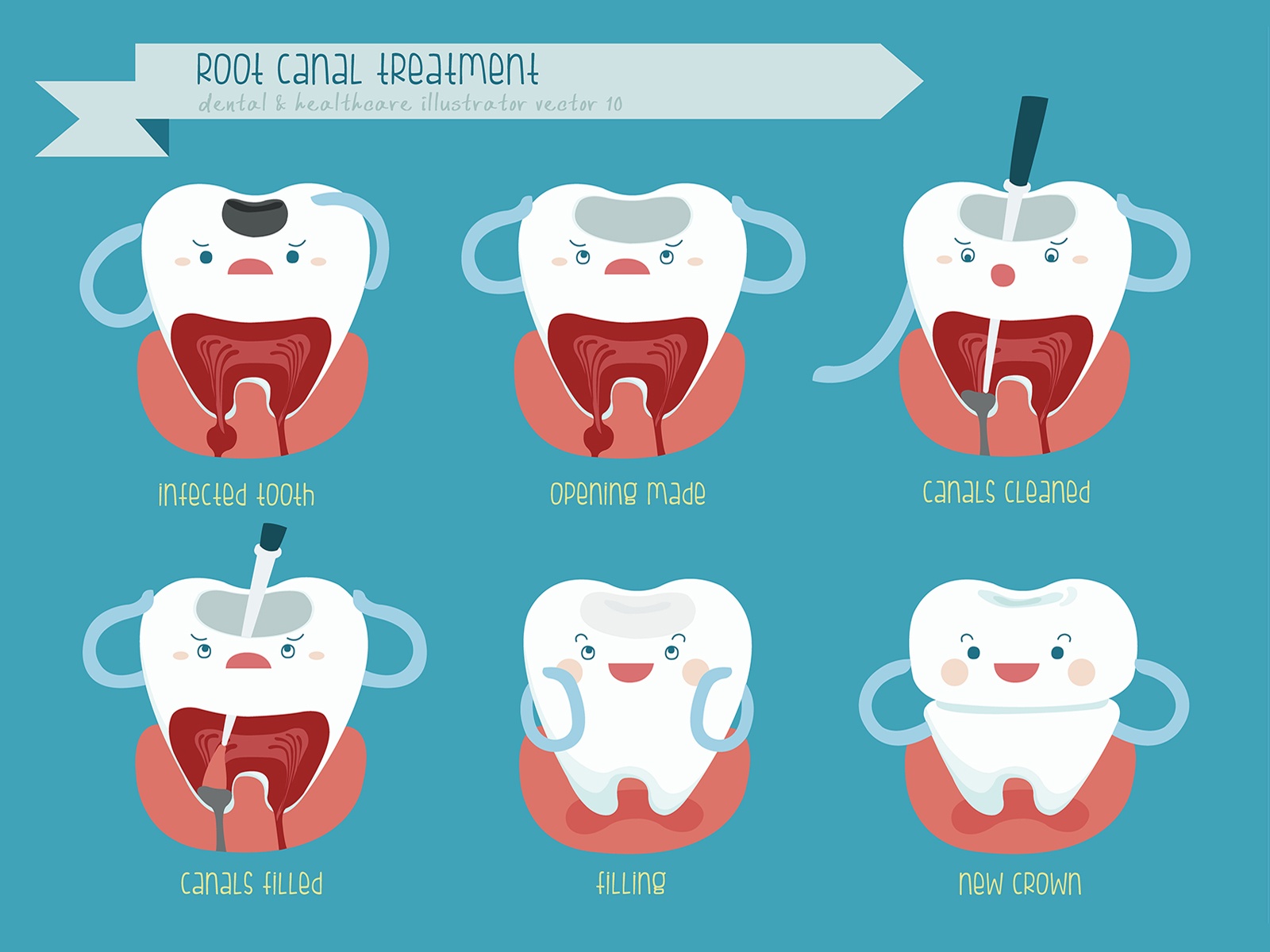 Can Root Canals Fail?