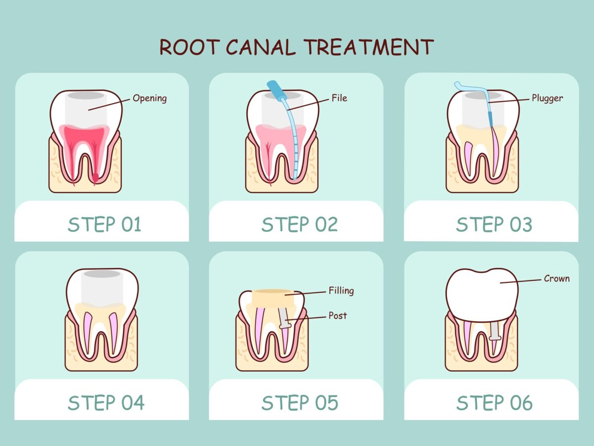 root canal bleed