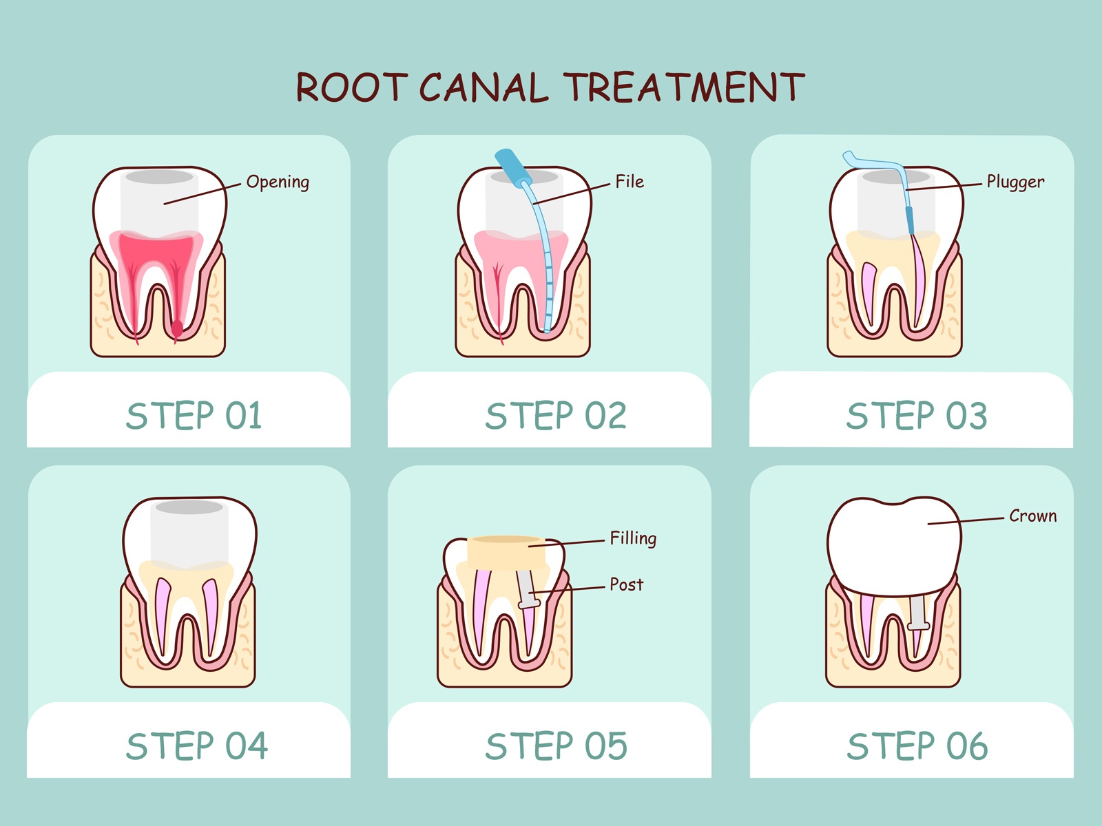 Does a root canal bleed?