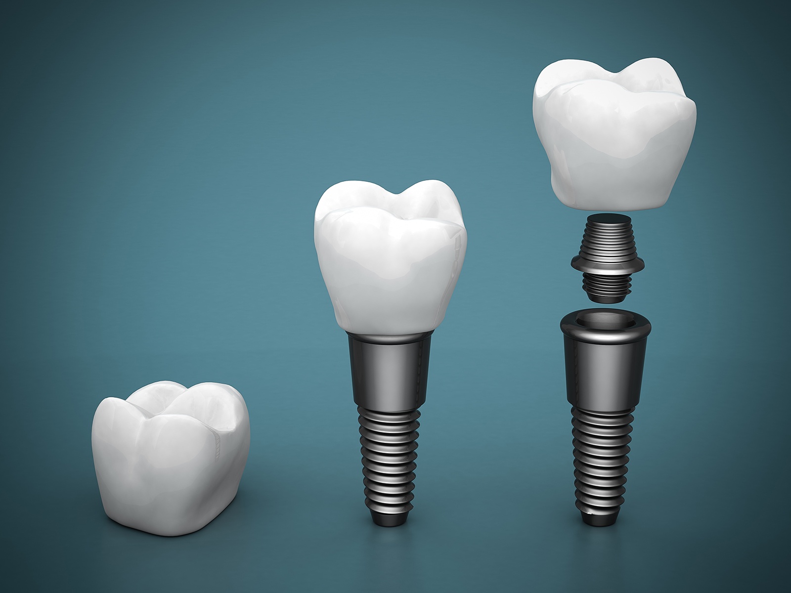 How is the implant attached to the abutment?