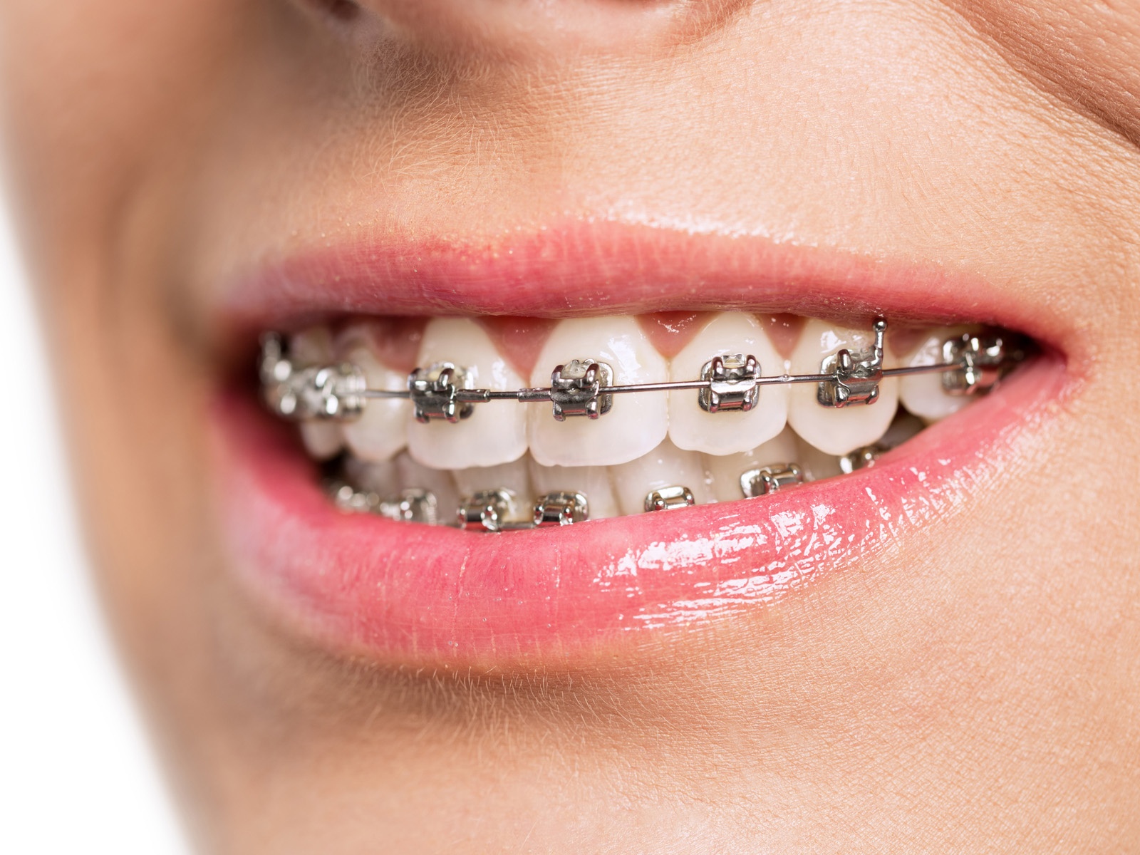Can you stop wearing your retainer after 10 years?