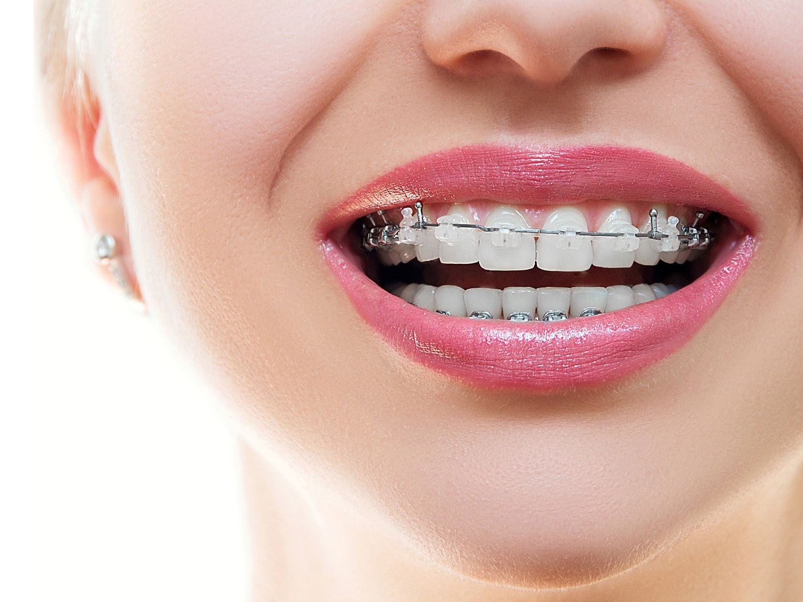 How many times a day should you brush with braces?