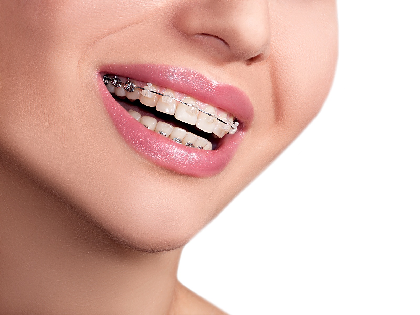 What are the side effects of braces?