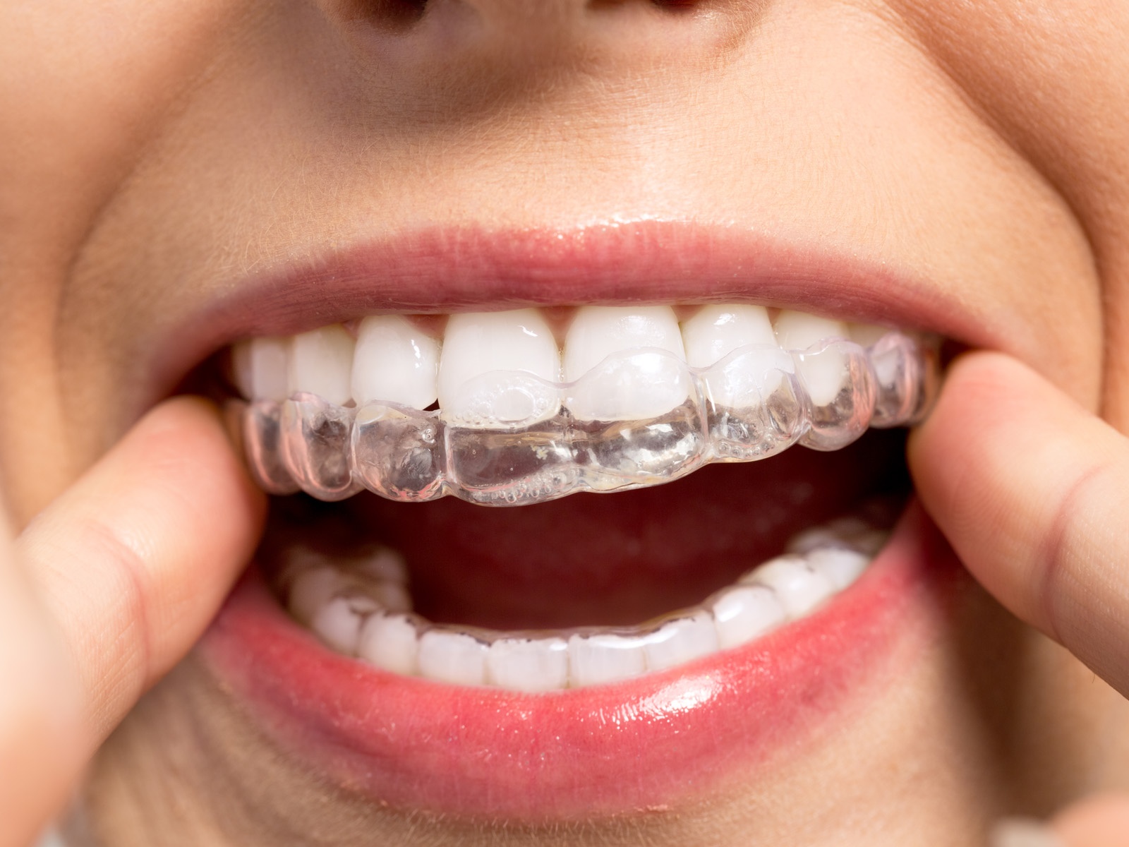 Can I Leave My Invisalign Out For a Day?