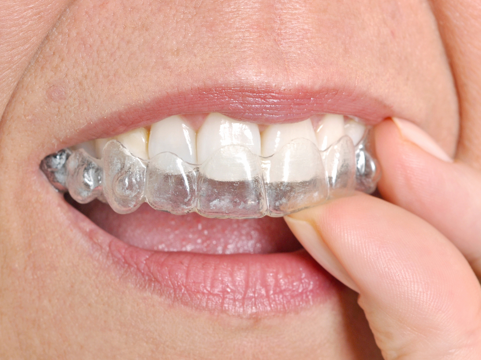 Is there an age limit for Invisalign?