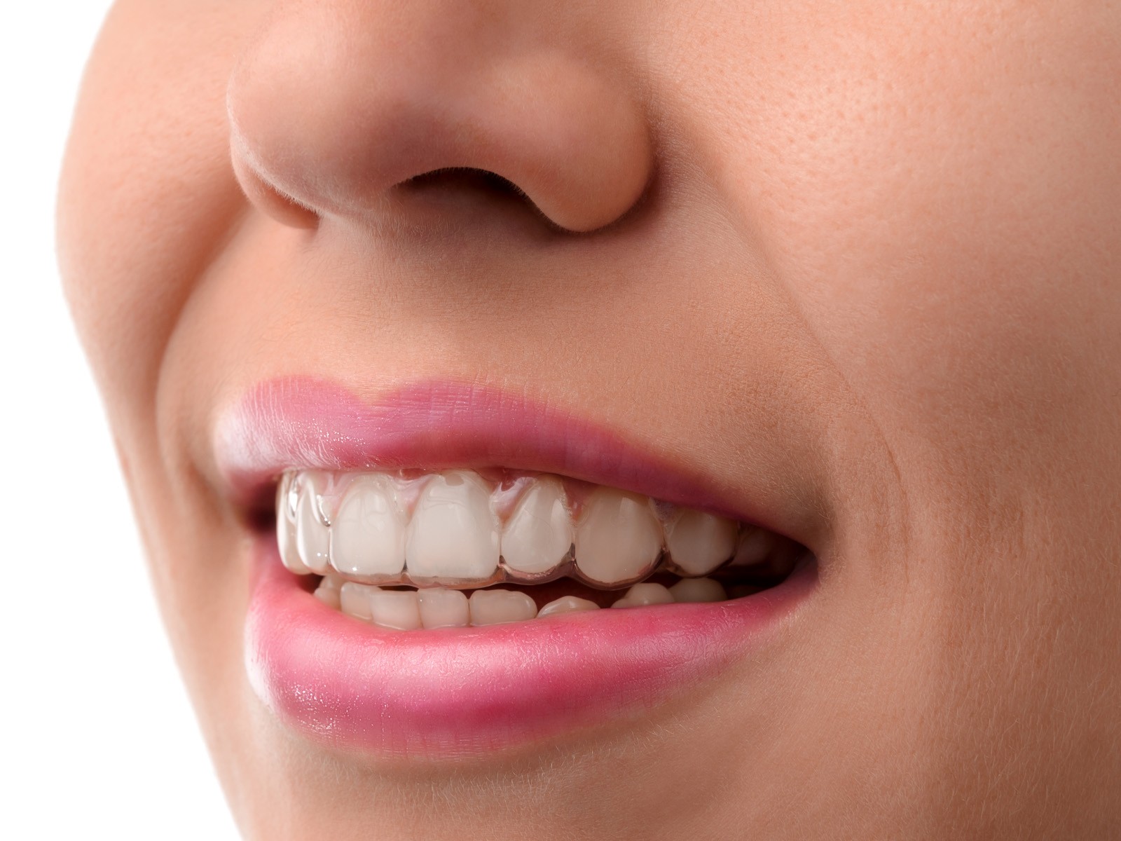 Does Invisalign make your lips bigger?