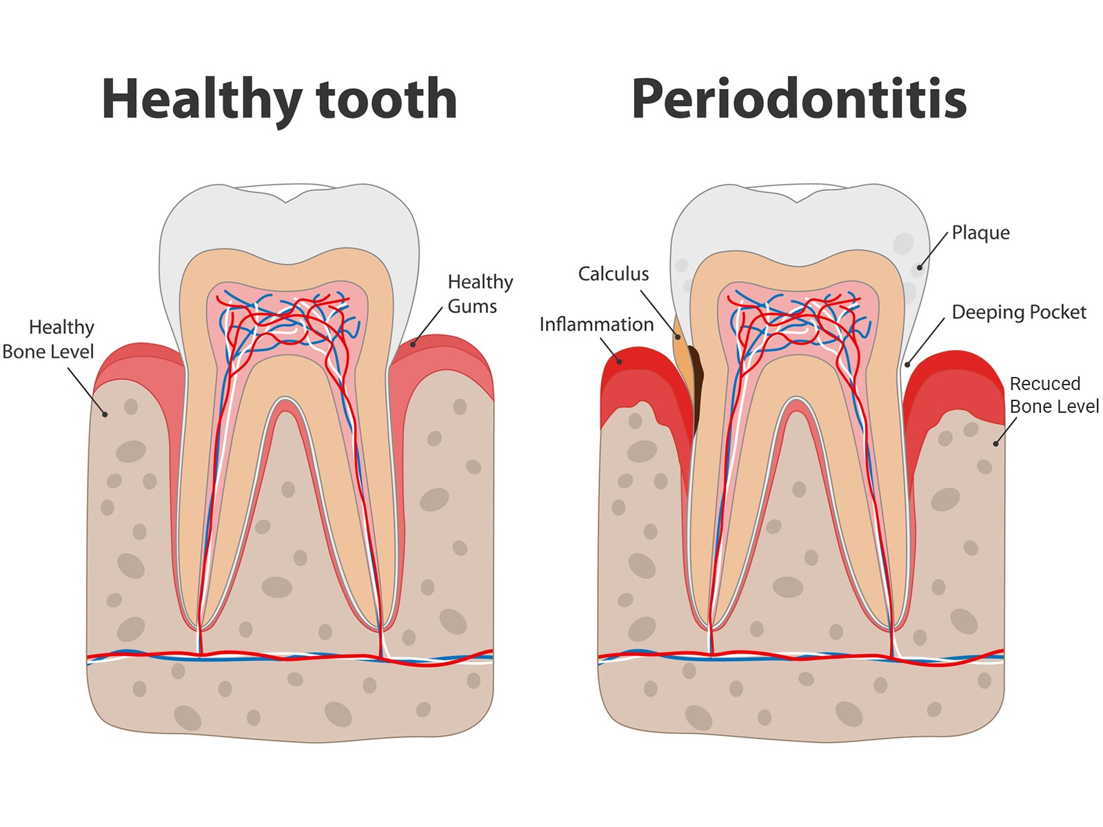 How to know when my periodontal disease is worse?