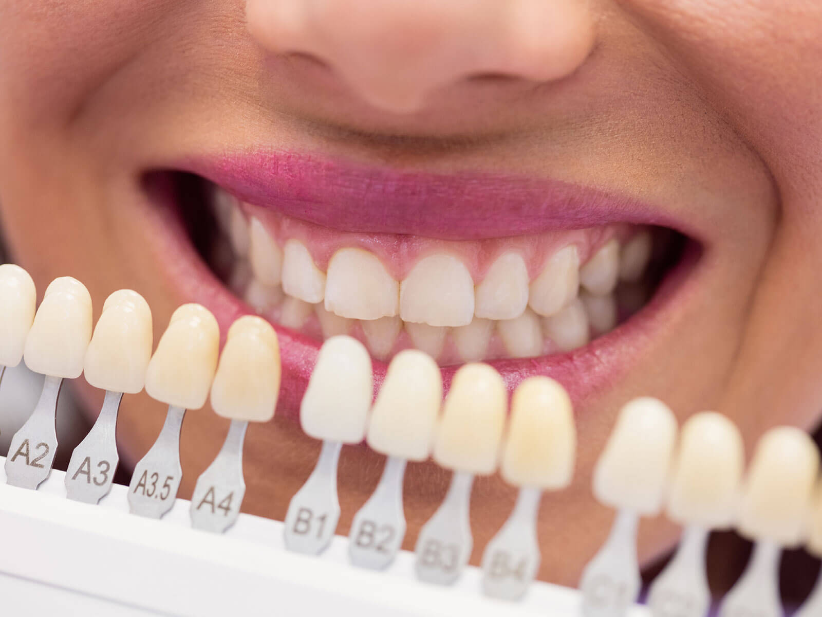 Common Misconceptions About Veneers: Debunking The Myths