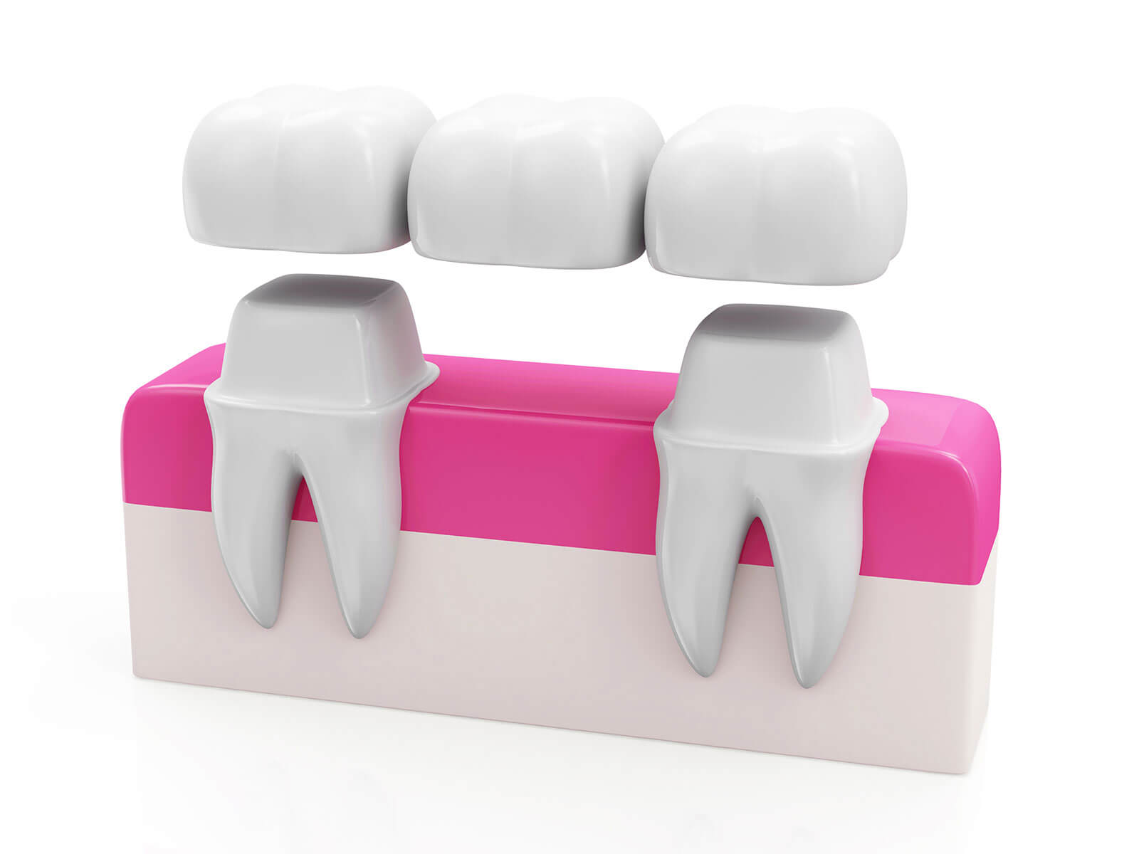 How Long Does A Fractured Jaw Take To Heal?