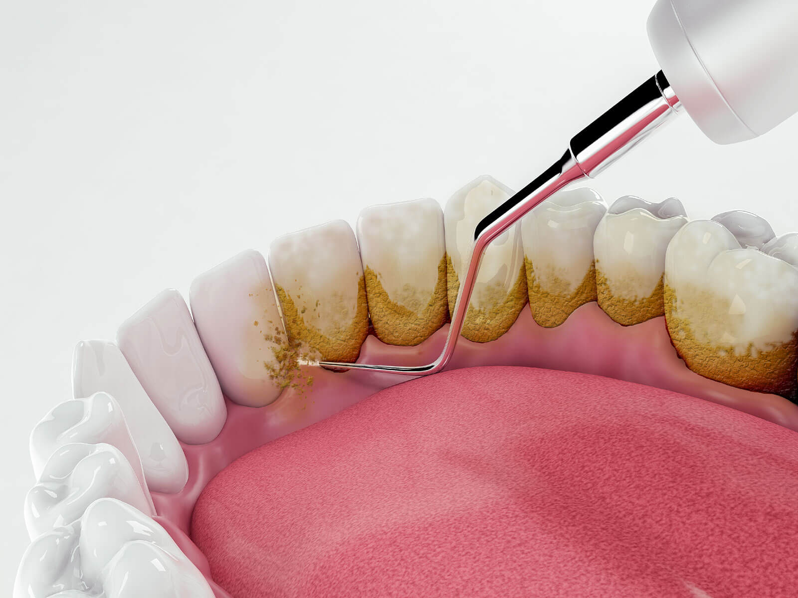 Uncover the Cause of Eroded Enamel