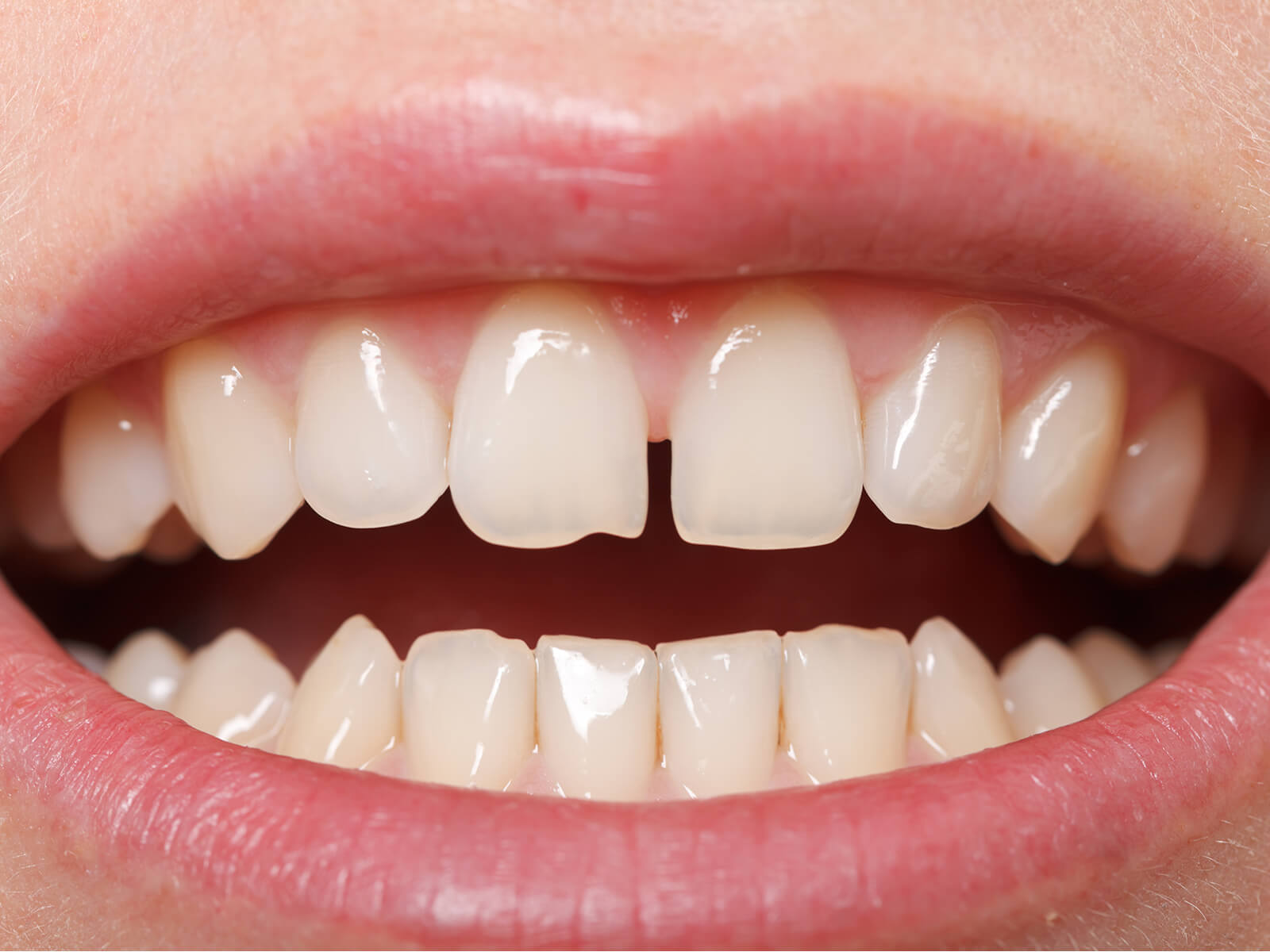 5 Options to Fill Your Tooth Gap for a Confident Smile