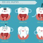 Managing Post-Root Canal Pain: Tips For A Smooth Recovery