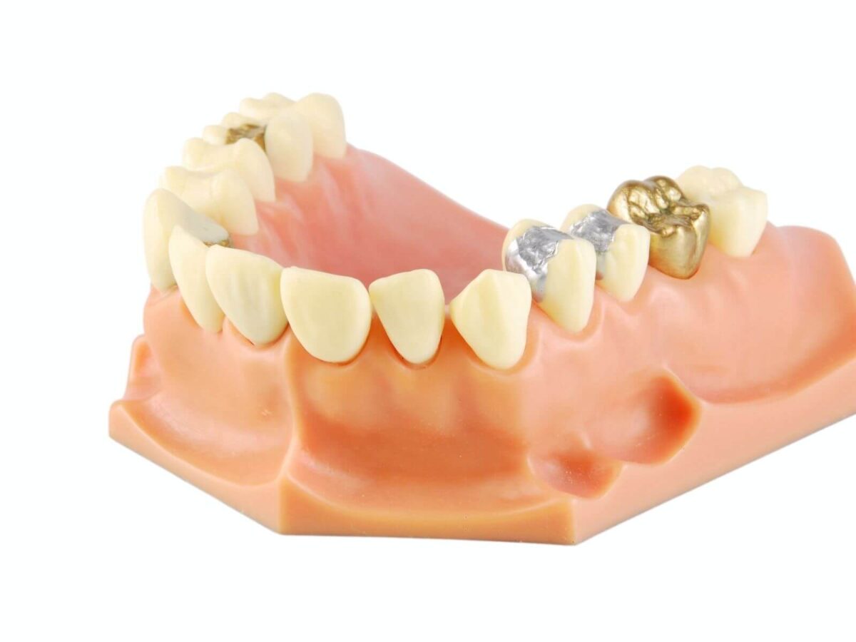 Types of Dental Fillings And Who Needs Them?