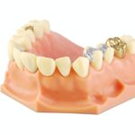 Types of Dental Fillings And Who Needs Them?