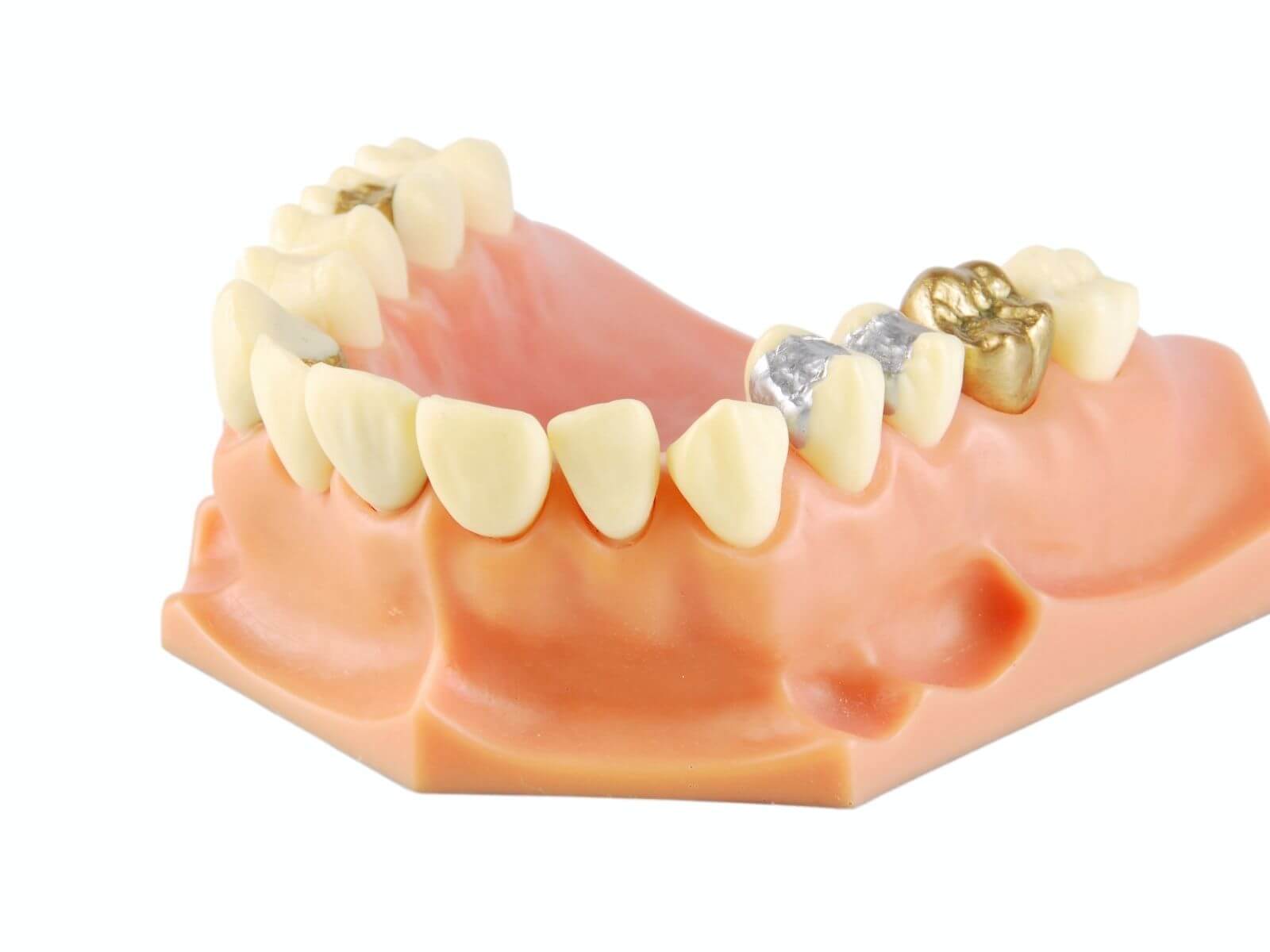 Types of Dental Fillings And Who Needs Them?