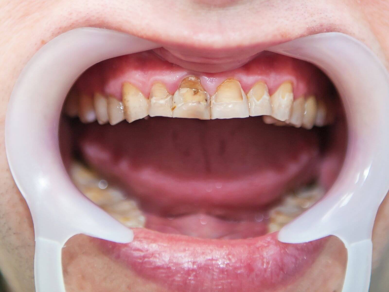Fluorosis: What It Is, Causes & Treatment