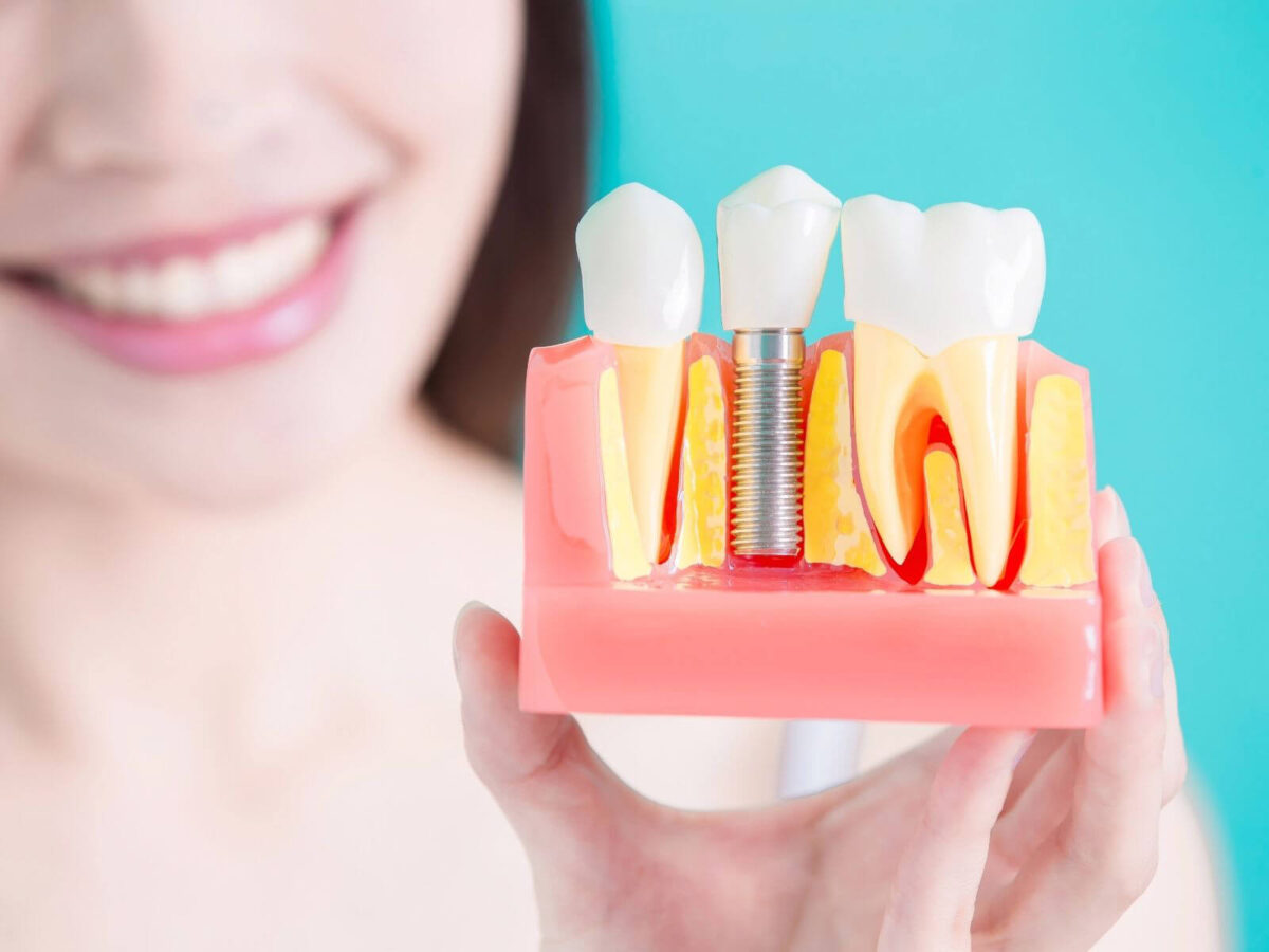 How Long Does A Dental Implant Take To Heal?