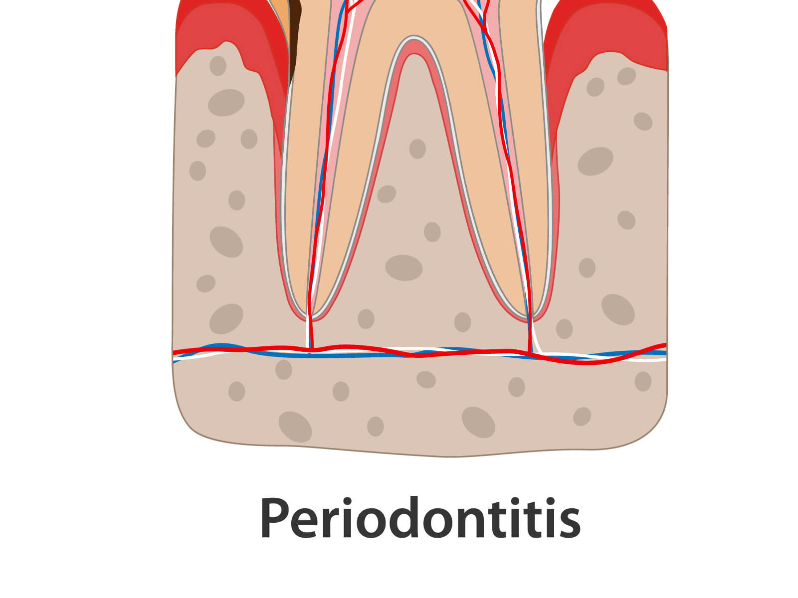 Gingivitis vs. Periodontitis: What’s the Difference?