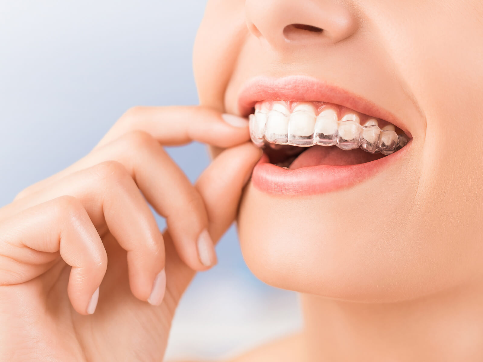 Top Benefits of Choosing Invisalign Over Traditional Braces