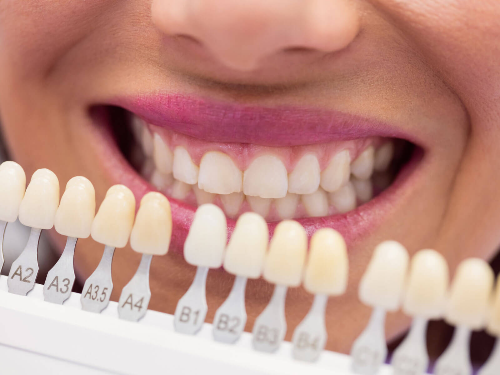 How Long Do Dental Crowns Last? Lifespan and Care Tips