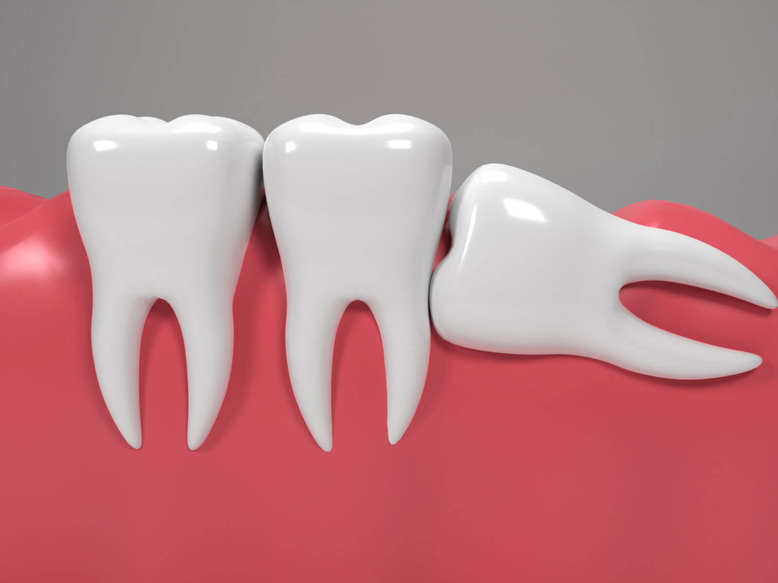 Why Are They Called Wisdom Teeth?