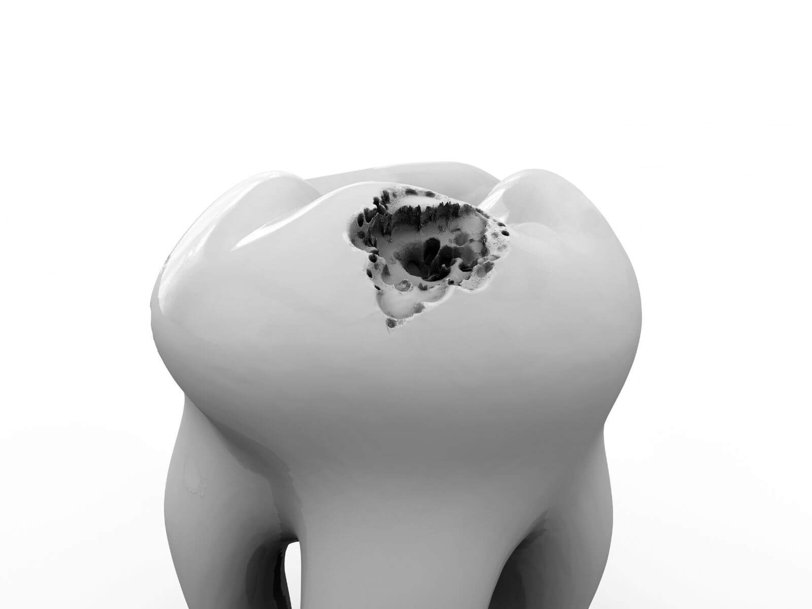 Black Dot on Tooth: Causes, What It Means, and How to Treat It