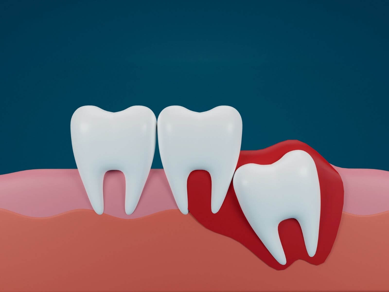 Can You Use a Straw After Wisdom Tooth Removal? When It’s Safe