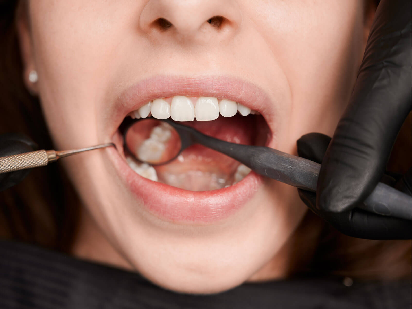 Root Canal Cost in Elgin, TX: What You’ll Pay With & Without Insurance